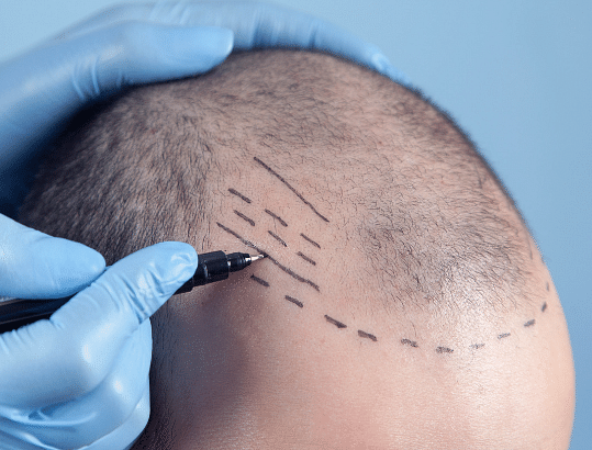 Best Skin Clinic in Jayanagar | Epiderma Clinic