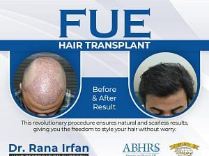 THE BEST HAIR TRANSPLANT IN ISLAMABAD