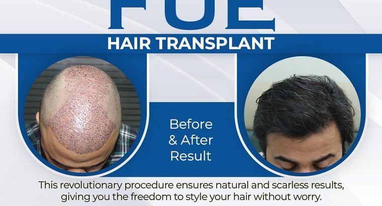THE BEST HAIR TRANSPLANT IN ISLAMABAD