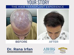 THE BEST HAIR TRANSPLANT IN ISLAMABAD