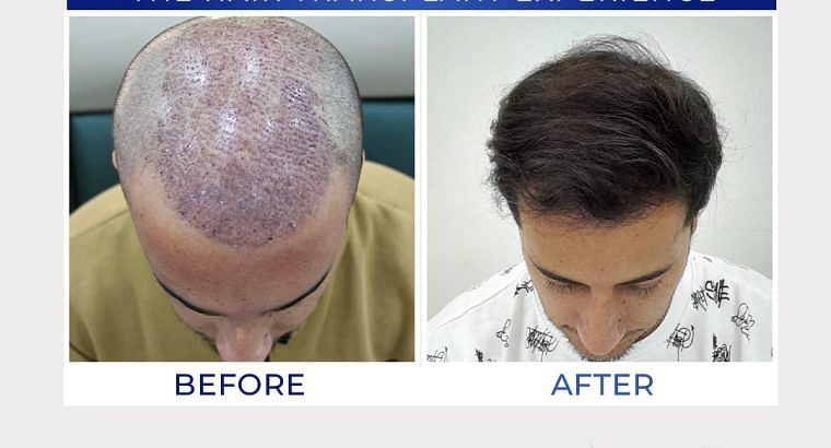 THE BEST HAIR TRANSPLANT IN ISLAMABAD