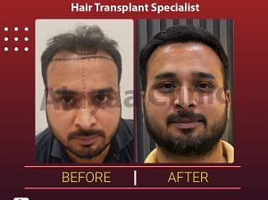 Premier Hair Transplant Specialist in Chandigarh Top Hair Restora
